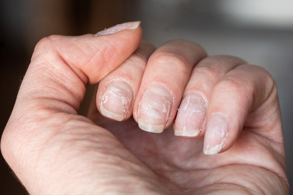 picture of brittle, damaged nails